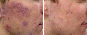 active_acne3_sult_rn-300x122