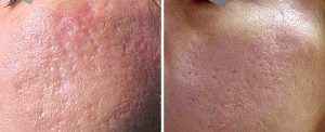 acne_scars_dr_luppino-300x122