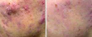 active_acne2_sult_rn-300x122