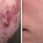 acne_treatment_kaliterna