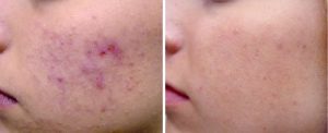 active_acne_sult_rn-300x122