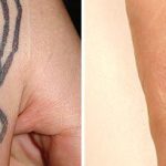 tattoo_removal_dr_ahcan2
