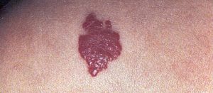 hemangioma of skin