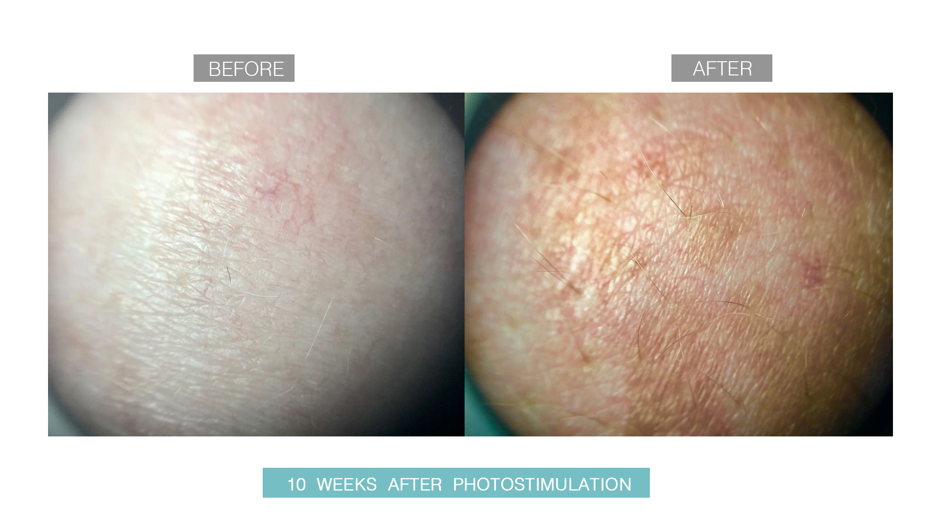 vitiligo-after-before-1