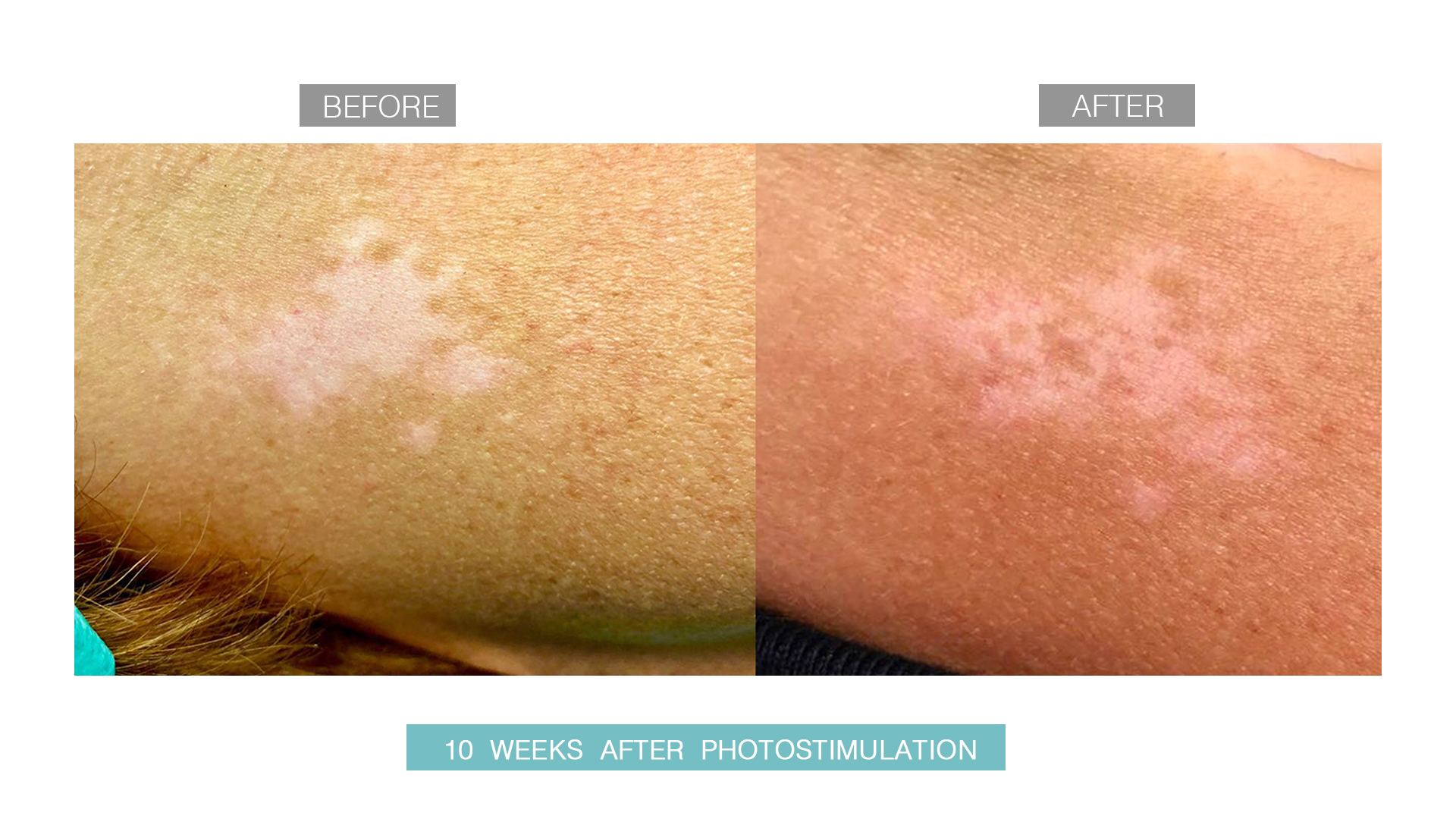 vitiligo-after-before-2