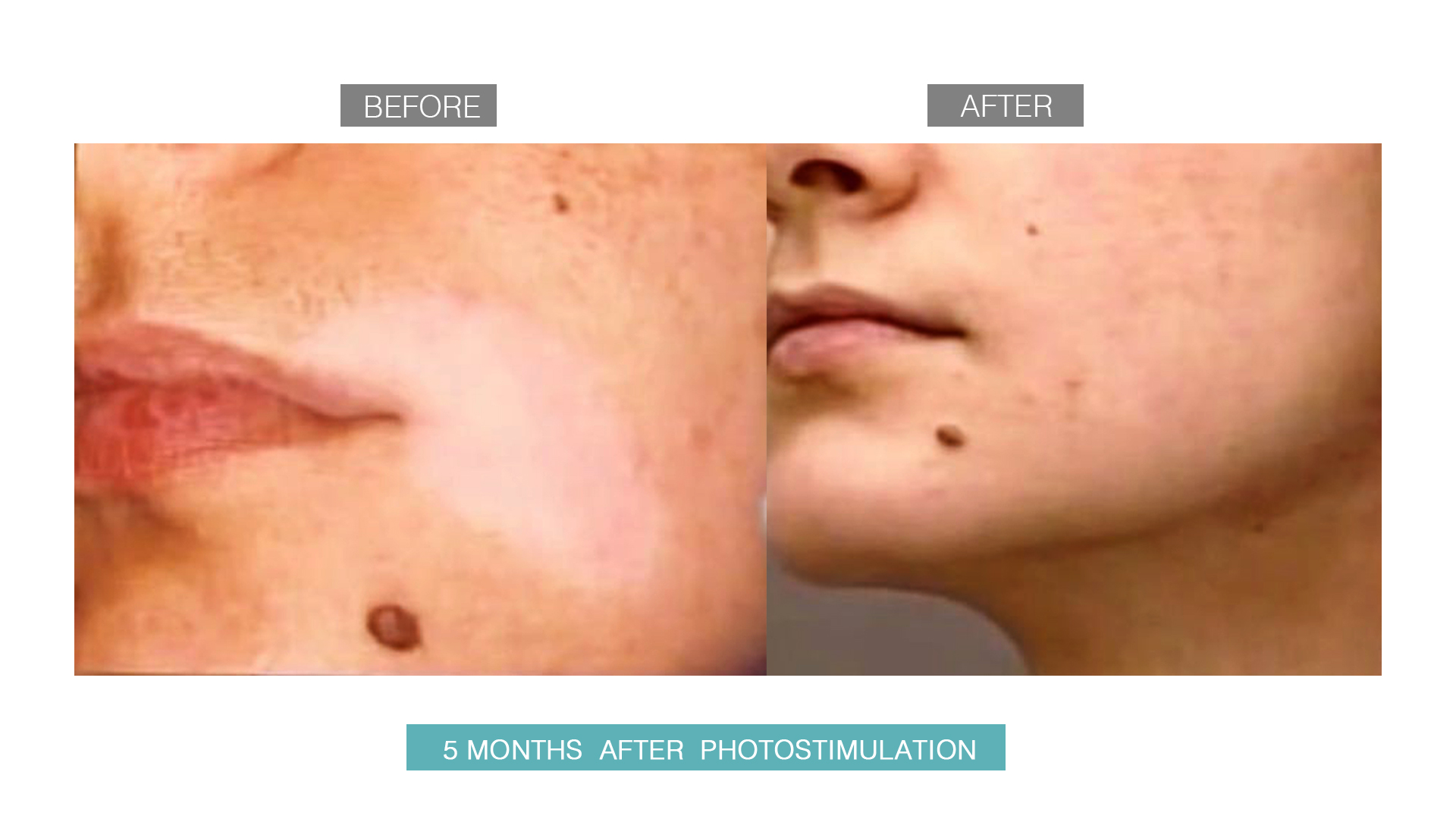 vitiligo-after-before-3