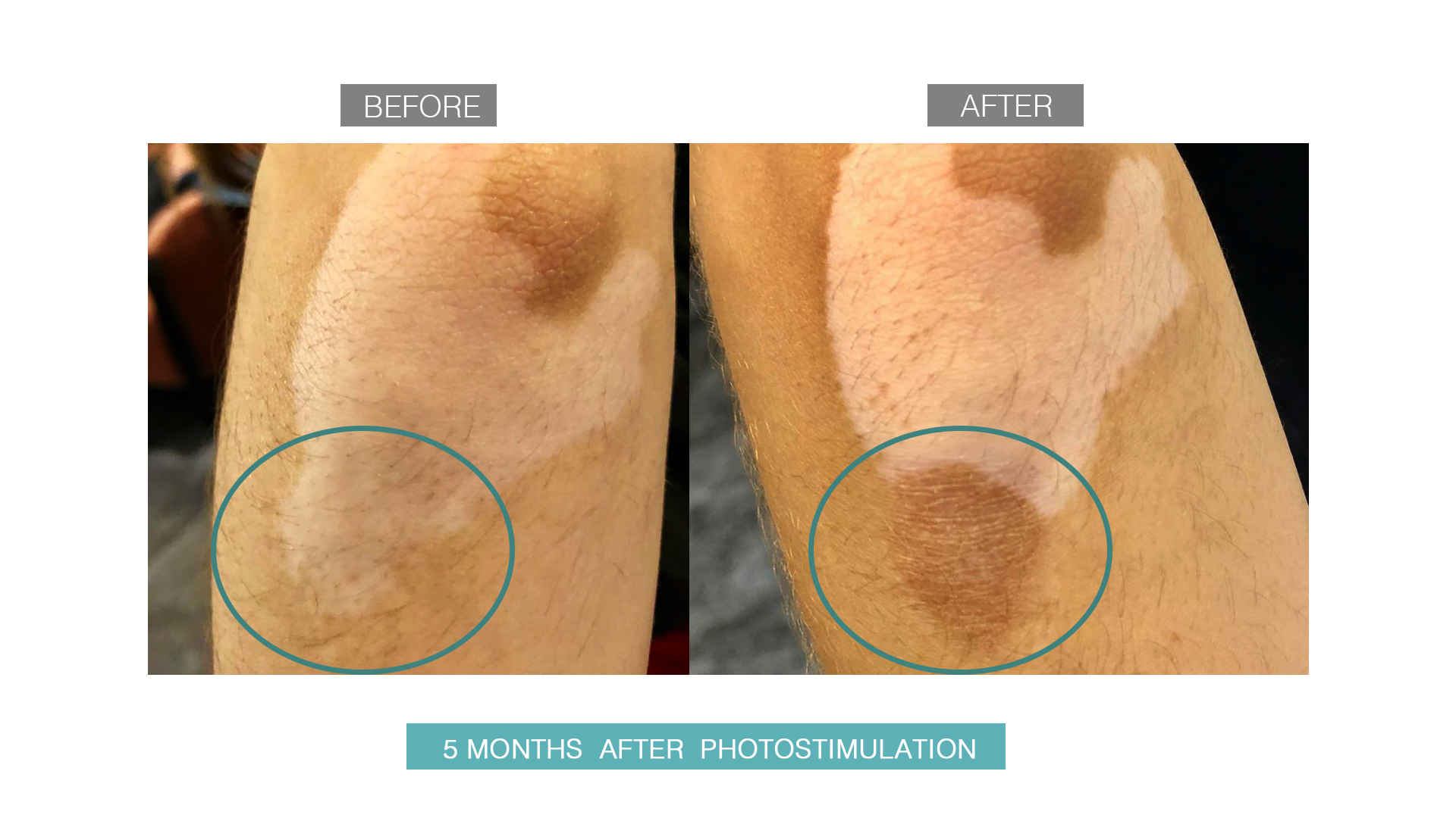 vitiligo-after-before-4