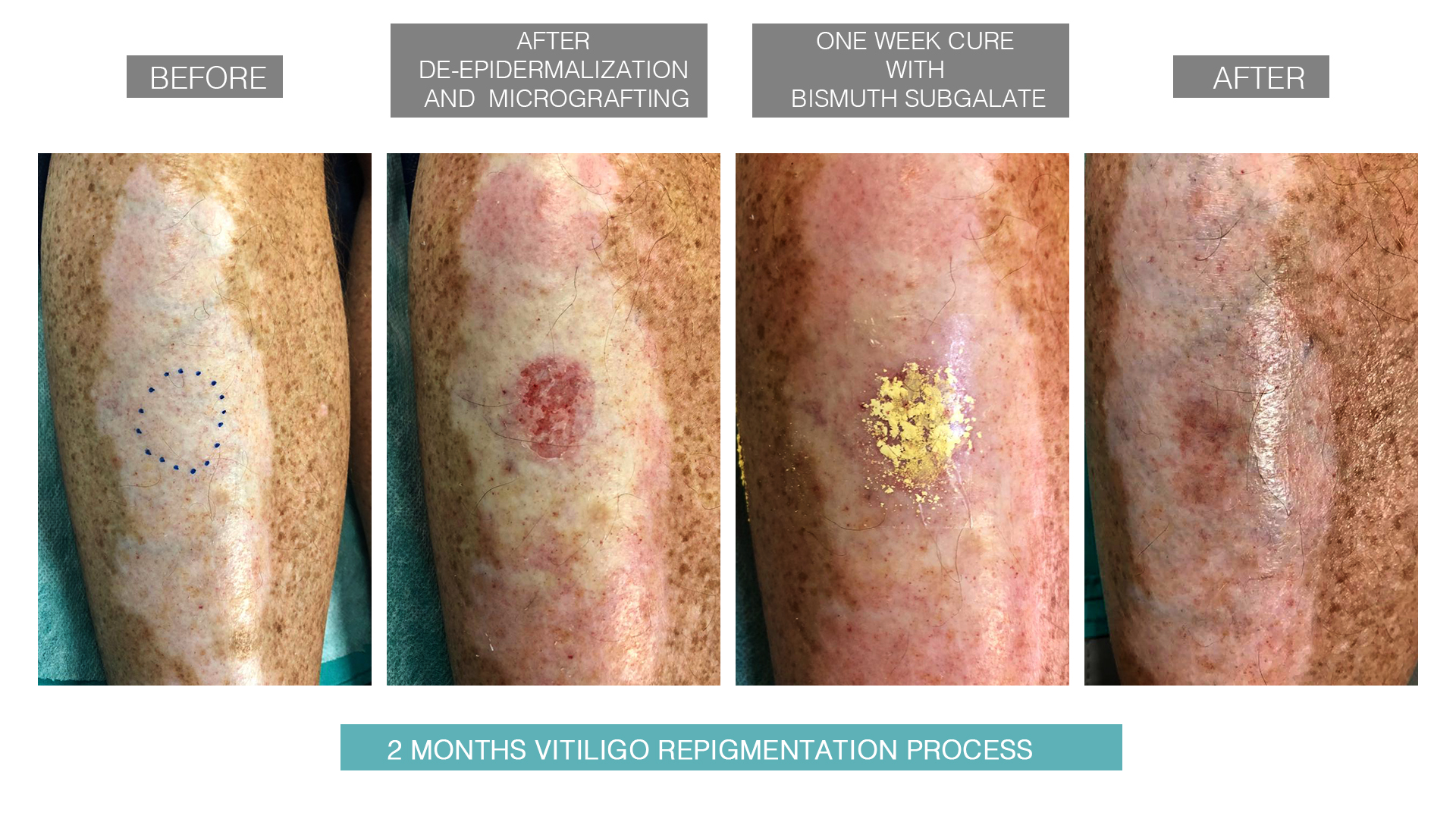 vitiligo-after-before-5
